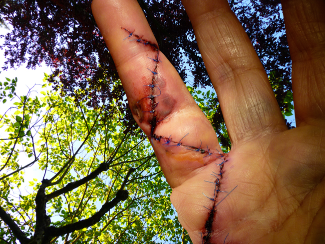 Injured walk